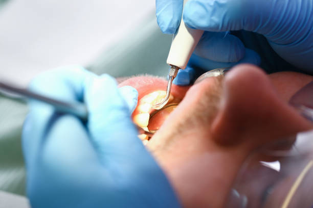 Best Emergency Root Canal Treatment in Dekal, IL