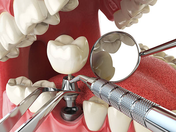 Best Emergency Dental Care for Broken or Chipped Teeth in Dekal, IL